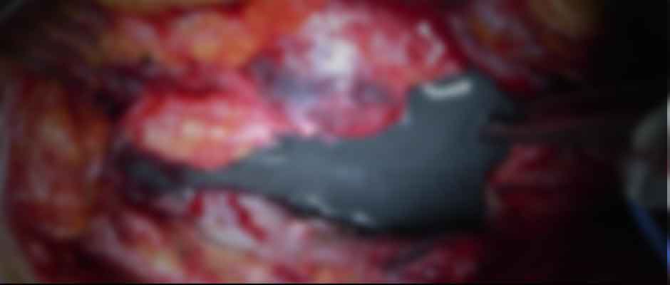 Damaged tissue from a defective metal on metal hip replacement