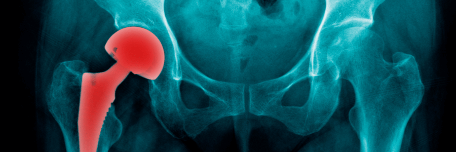 Defective metal on metal hip implant xray 