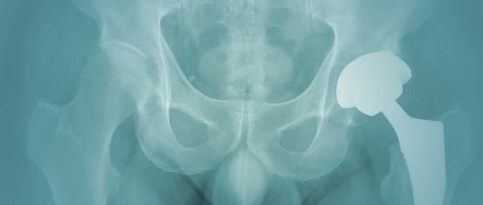 xray of metal on metal hip replacement 