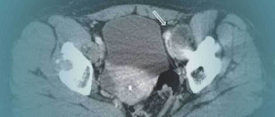Defective metal on metal hip replacement 