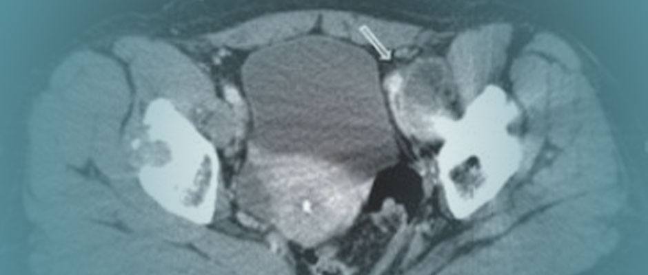 Defective metal on metal hip replacement