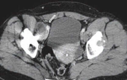 MRI of a patient with pseudotumors due to defective metal on metal hip replacements