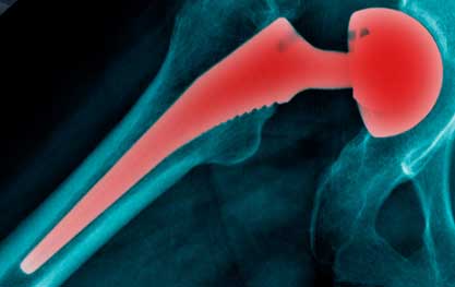 X-ray of a patient with a defective metal on metal hip replacement