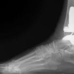 x-ray of Exactech ankle replacement