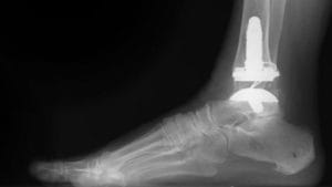 x-ray of Exactech ankle replacement