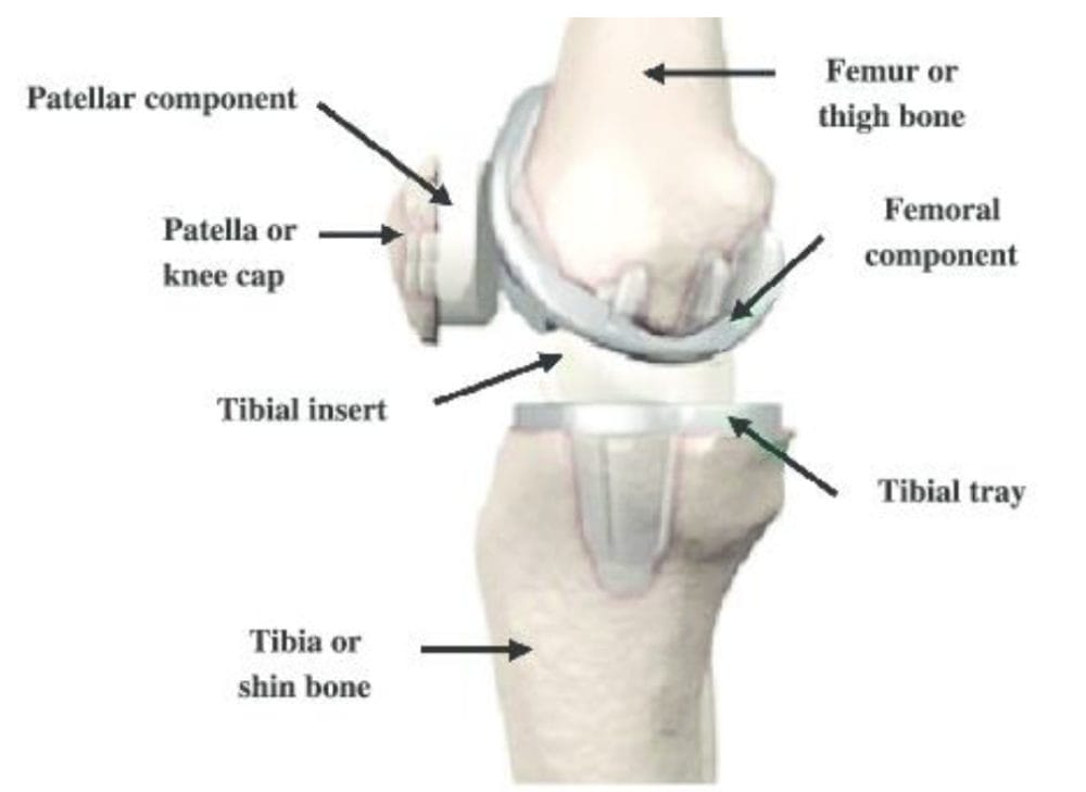 Diagram of Exactech Knee Replacement 