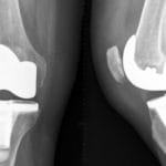 x-ray of defective Exactech Knee Replacement