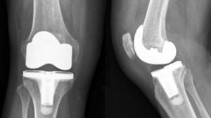 x-ray of defective Exactech Knee Replacement