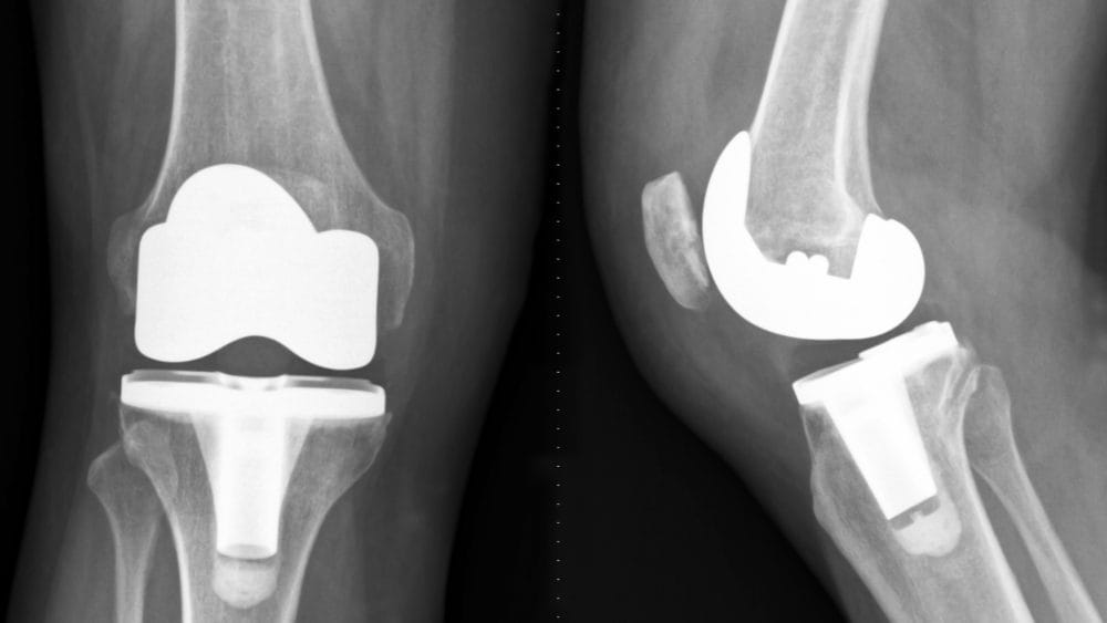 Exactech knee replacement xray 