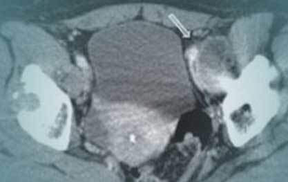 Xray of pseudotumors in patient who has defective metal on metal hip replacements