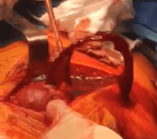Revision Surgery of patient with defective metal on metal hip replacement
