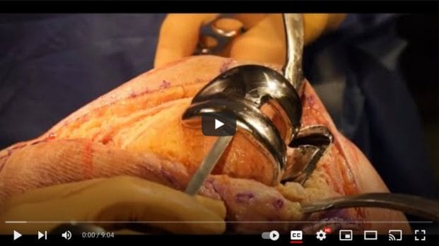 Video of Knee Revision Surgery 