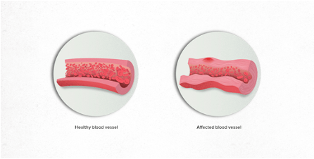 Comparison Between Healthy Blood Vessel and Blood Vessel with Vasculitis
