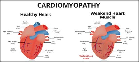 Graphic showing a healthy heart vs a heart with cobalt cardiomyopathy
