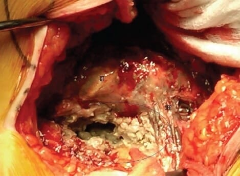 Cobalt chromium poisoning from a defective metal on metal hip replacement