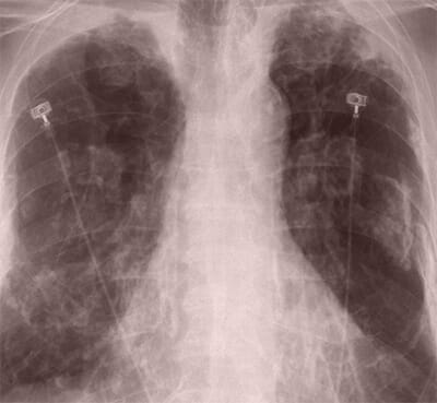 xray of lungs with lung cancer