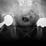 xray of defective metal on metal hip replacements