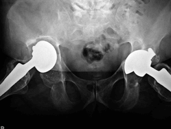 xray of defective metal on metal hip replacements